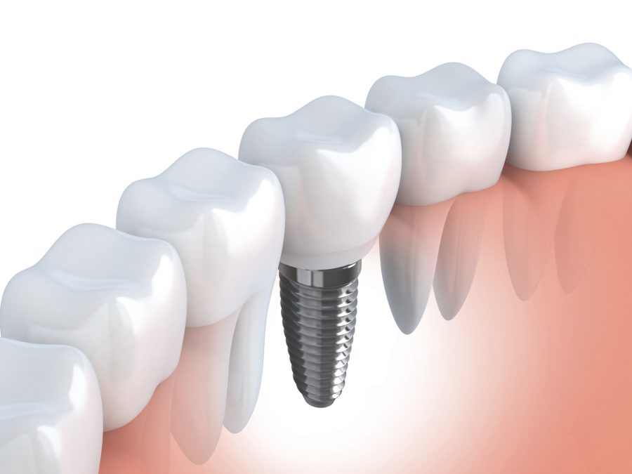 Are Dental Implants Worth the Cost?