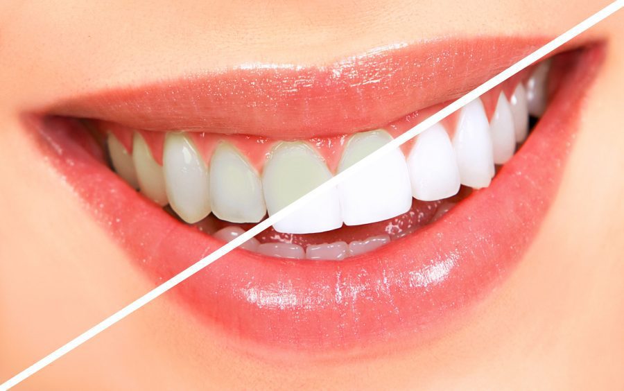 All You Need To Know About Teeth Whitening Procedure