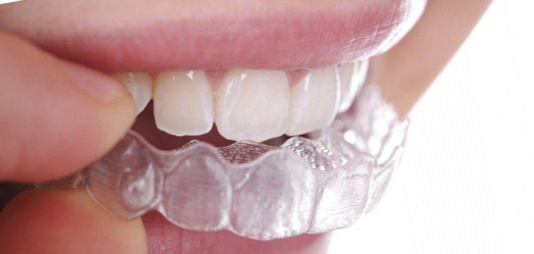 Straighten Your Smile with Invisible Braces