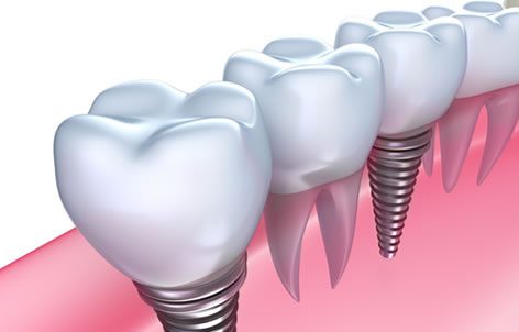 DENTAL IMPLANTS SYDNEY $1500