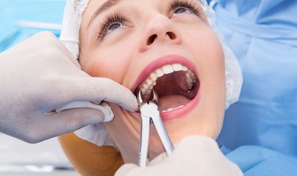 How Much Does It Cost To Get Wisdom Teeth Removed