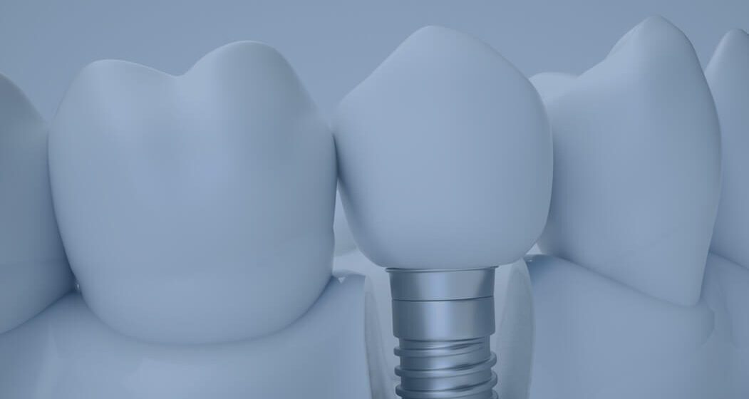  Dental Implant Practice in Sydney