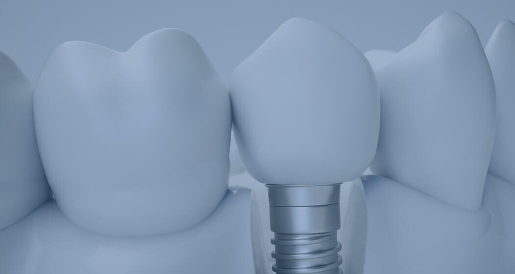 Dental Implant Practice in Sydney