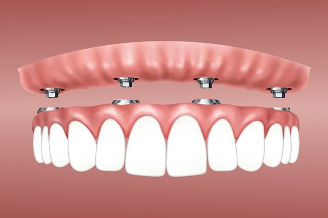 Why Dental Implants are Worth Investing on? Know these 5 Reasons