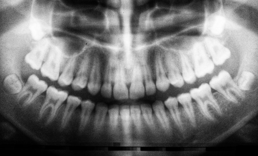 Wisdom Teeth Removal and Recovery Time! Wisdom Teeth Removal and Recovery Time!