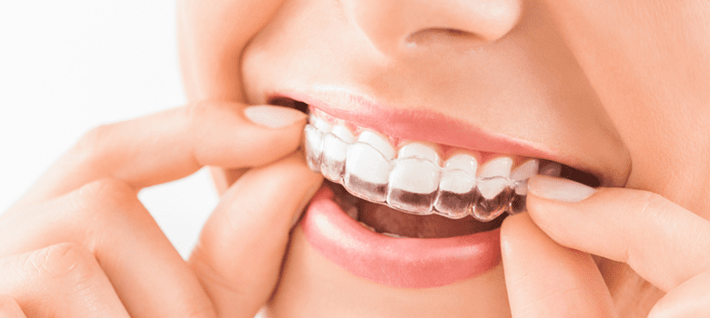Why Should You Consider Getting Invisible Braces?