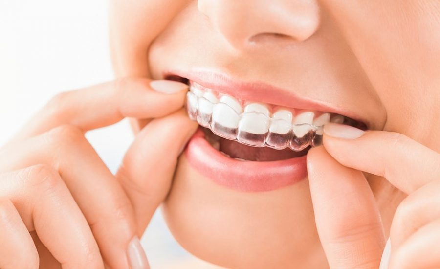 Everything you should know about Invisible Braces!