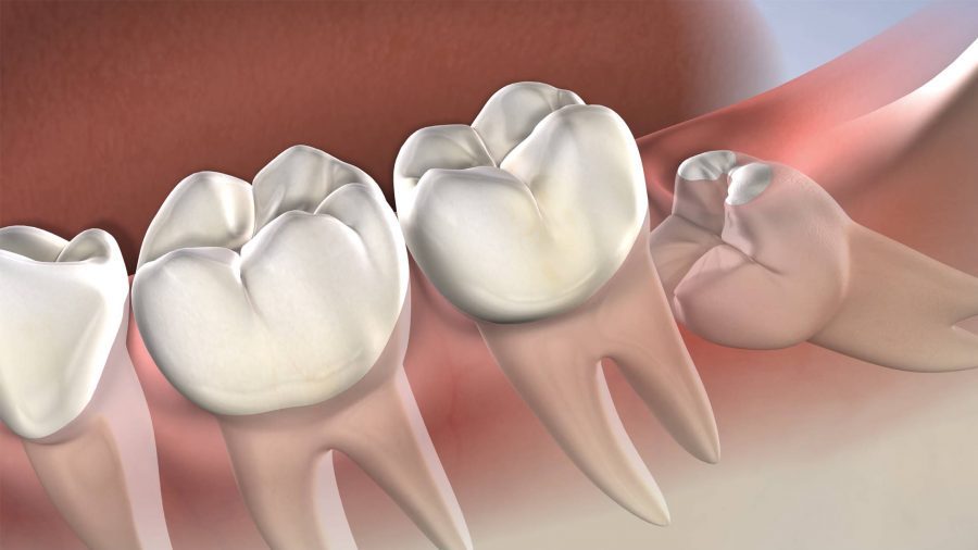 Symptoms that indicate you should undergo Wisdom Teeth Removal Procedure