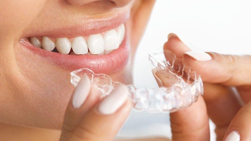 Invisible Braces vs. Conventional Braces – Which Is Better