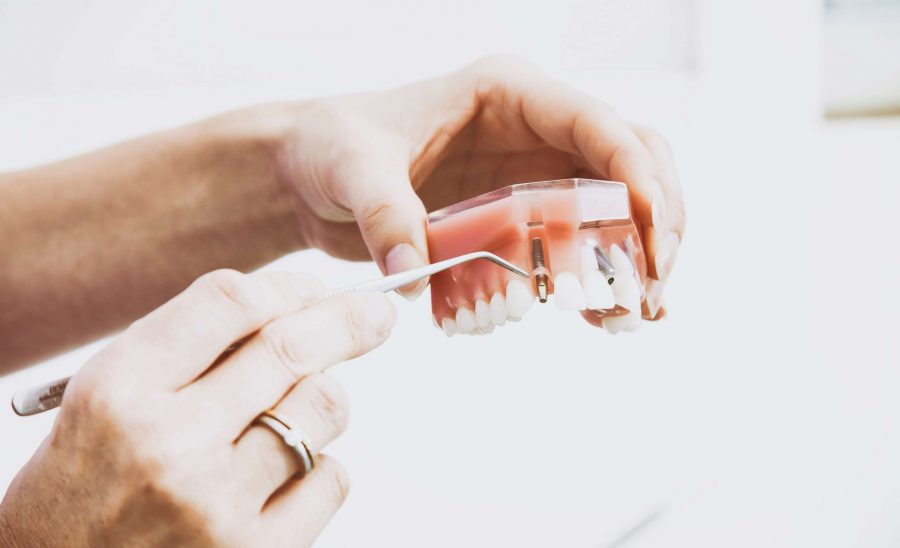 How to Take Care of Your Dental Implants