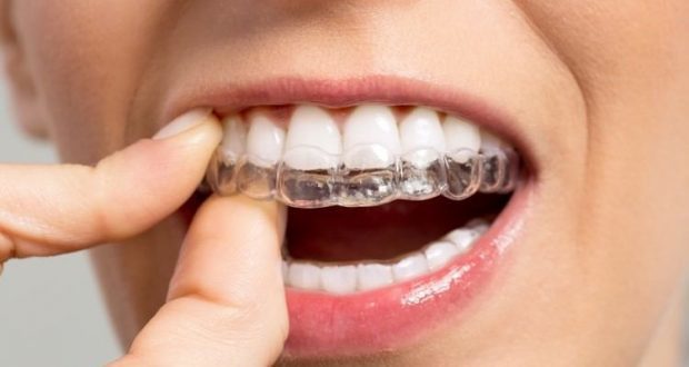 Invisible Braces Are the Perfect Solution for Orthodontic Issues