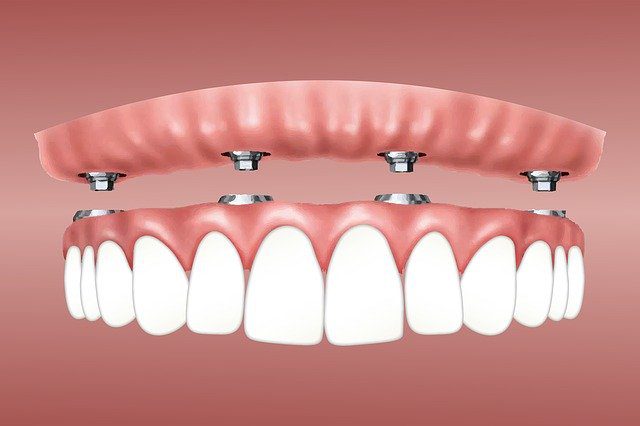 Why Consider Dental Implants Over Other Tooth Restoration Methods?