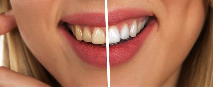 Why You Should Whiten Your Teeth Professionally And Regularly?