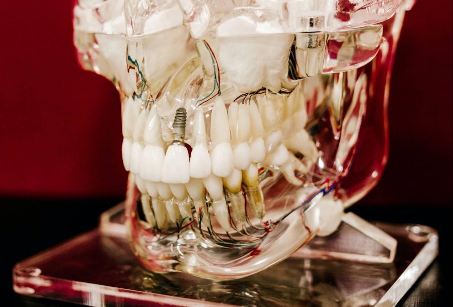 Myths and Facts about Dental Implants