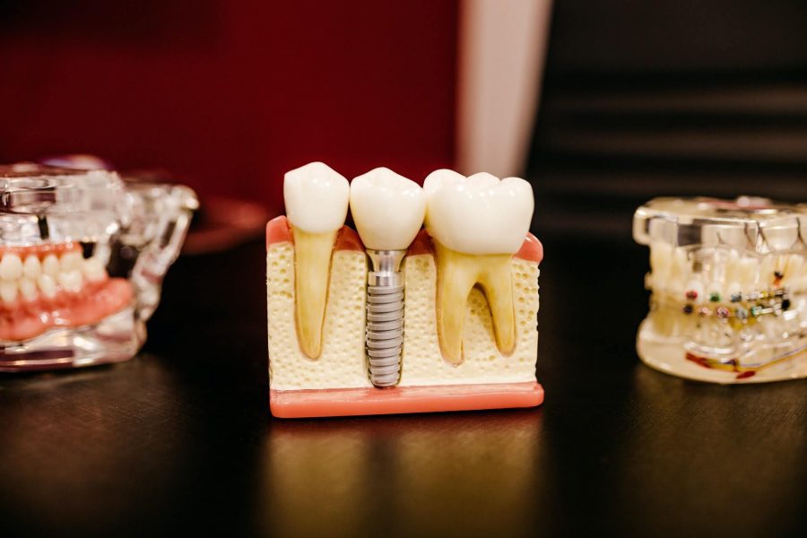 What Are The Benefits Of Dental Implants?