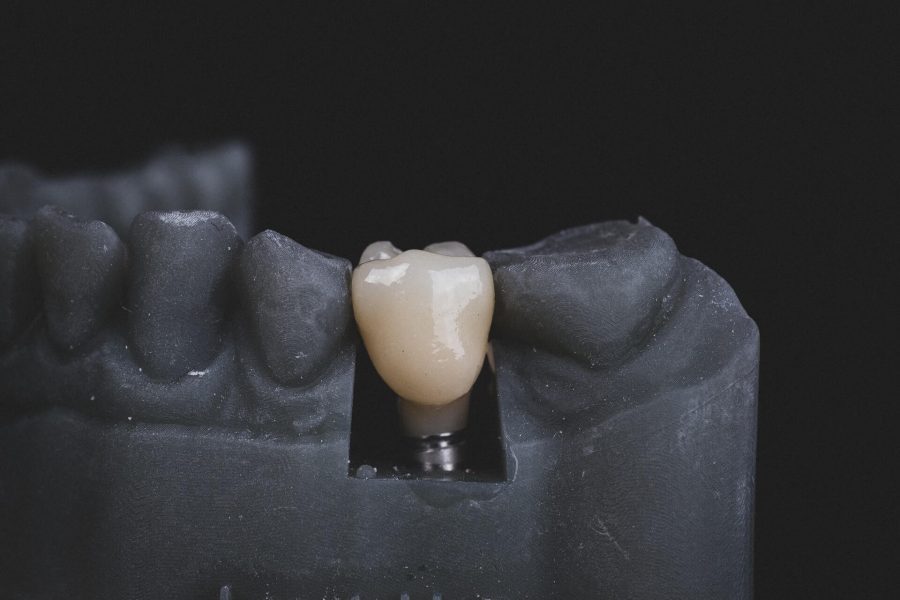 5 Common Problems that can be Resolved by Dental Implants