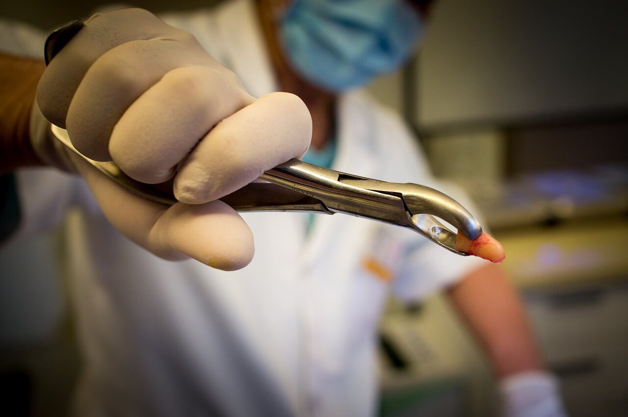 What after Wisdom Teeth Removal? 99 Affordable Dentist Sydney