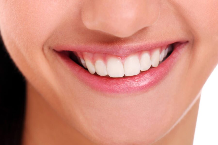 What to Eat and Avoid After Teeth Whitening in Sydney