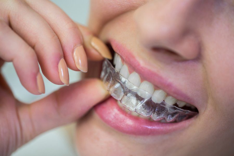 Invisible Braces Sydney: What to Expect?