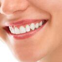 Teeth Whitening Sydney – A Definitive Guide to Teeth Whitening
