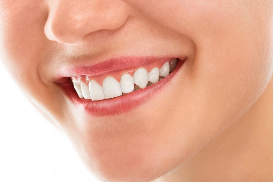 Teeth Whitening Sydney – A Definitive Guide to Teeth Whitening