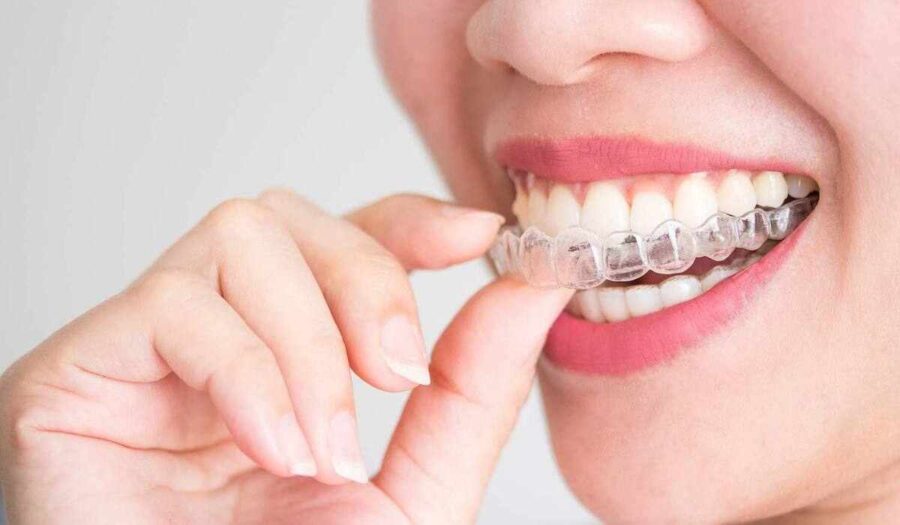 What Affects The Cost Of Invisible Braces?