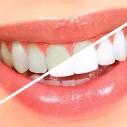 Signs You Need Teeth Whitening