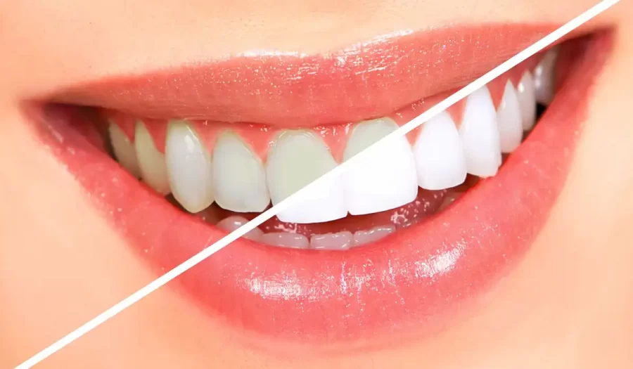 Signs You Need Teeth Whitening