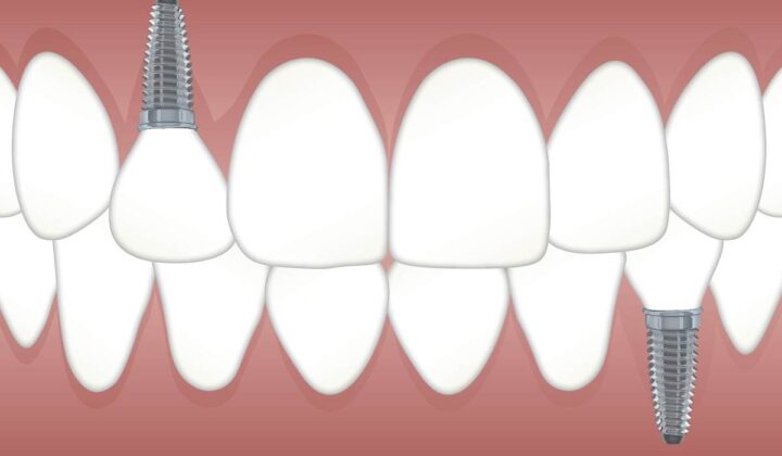 Dental implants Sydney