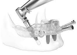 affordable dental implants Sydney