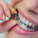 An Ultimate Guide to Invisible Braces
