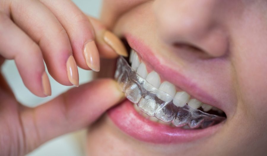 An Ultimate Guide to Invisible Braces