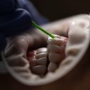 8 Long-Term Benefits of Wisdom Teeth Removal You Should Know