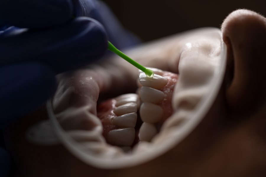 8 Long-Term Benefits of Wisdom Teeth Removal You Should Know