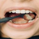 Anaesthesia Options for Wisdom Teeth Removal to Know