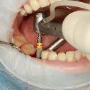 What You Need to Know About Dental Implants: The Process and Outcomes of the Treatment