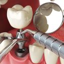 The Journey of Dental Implant Procedure: Understanding Each Step