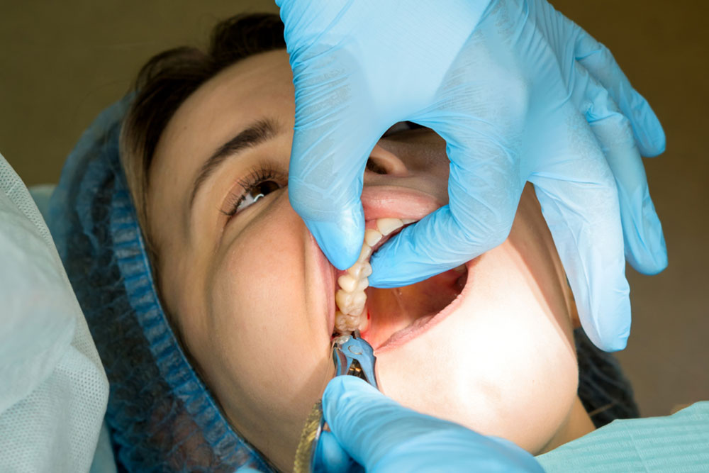 Safe and affordable wisdom teeth removal at modern dental clinic