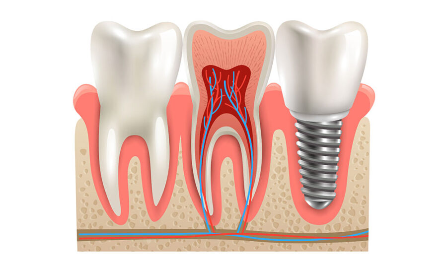 Can You Get Dental Implants Without Bone Grafting? What You Need to Know